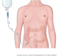 Mace Colon MACE (Malone Antegrade Continence Enema) Procedure - QLD Stoma Association